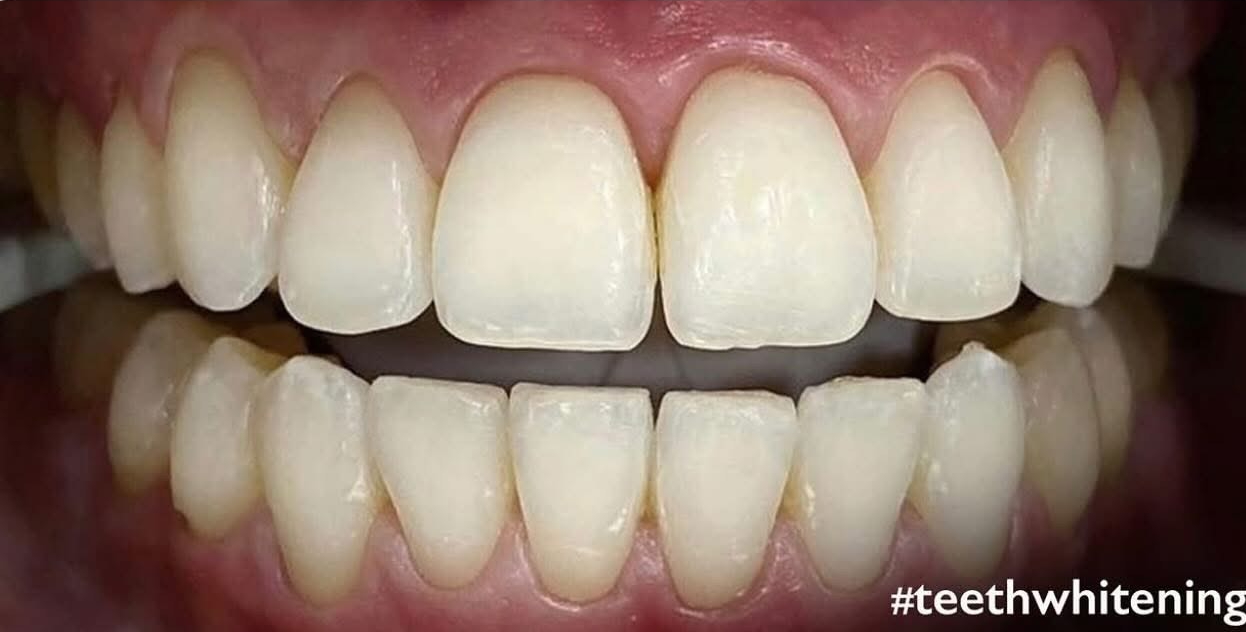 Teeth Cleaning & Polishing 1